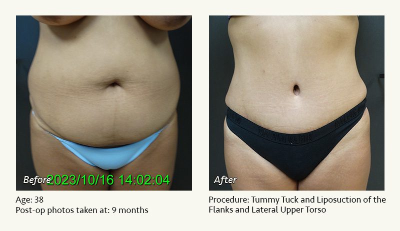 Tummy Tuck in Plano, TX - Patient 11