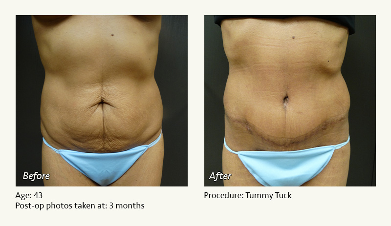 Tummy Tuck in Plano, TX - Patient 1