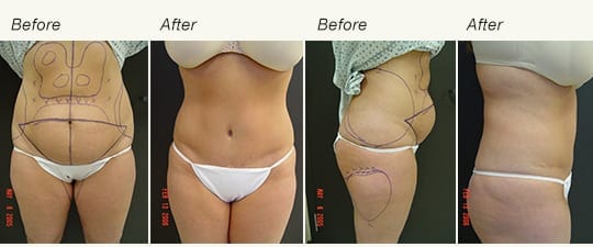 Tummy Tuck Results 1