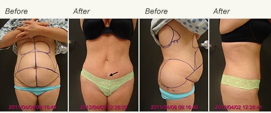 Tummy Tuck Results 2