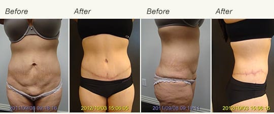 Tummy Tuck Results 4