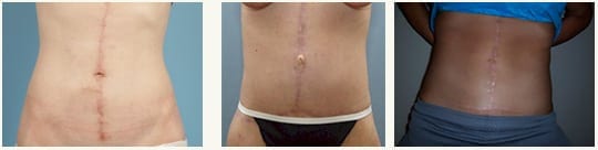 Tummy Tuck Results 6