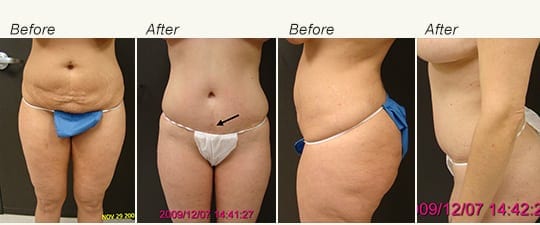 Will Tummy Tuck Scars Go Away? Effective Strategies to Reduce