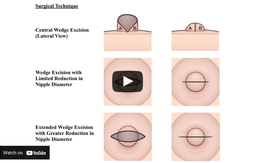 Nipple reduction video