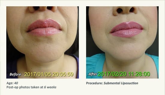 Chin Liposuction in Plano, TX - Patient 61