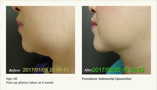 Chin Liposuction in Plano, TX - Patient 62