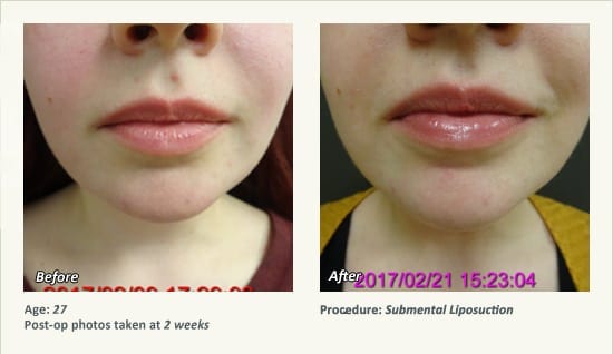 Chin Liposuction in Plano, TX - Patient 63