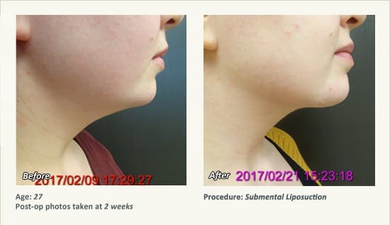 Chin Liposuction in Plano, TX - Patient 64