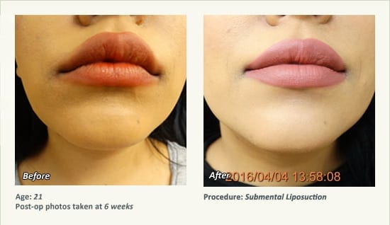 Chin Liposuction in Plano, TX - Patient 67