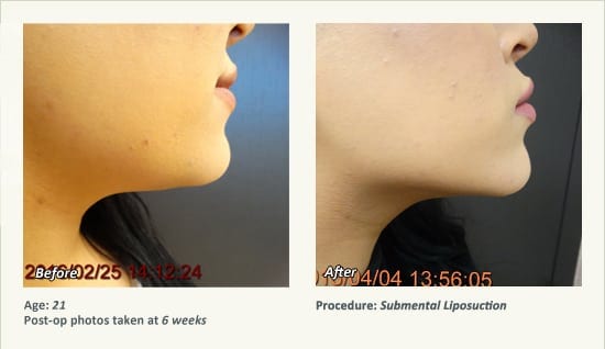 Chin Liposuction in Plano, TX - Patient 68