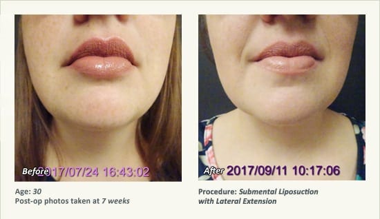 Chin Liposuction in Plano, TX - Patient 71