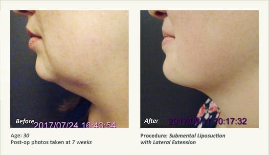 Chin Liposuction in Plano, TX - Patient 72