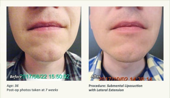 Chin Liposuction in Plano, TX - Patient 73
