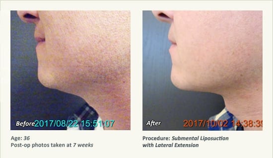 Chin Liposuction in Plano, TX - Patient 74