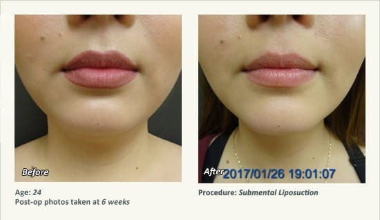 Chin Liposuction in Plano, TX - Patient 43