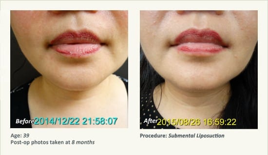 Chin Liposuction in Plano, TX - Patient 45