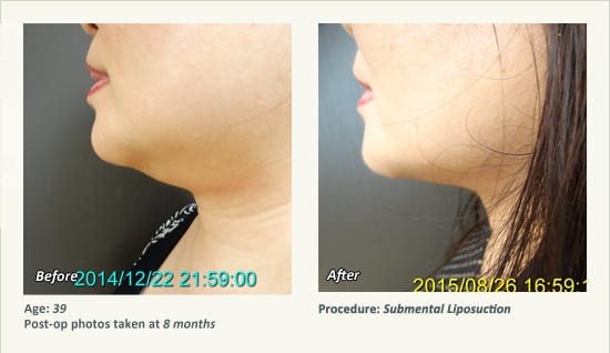 Chin Liposuction in Plano, TX - Patient 46