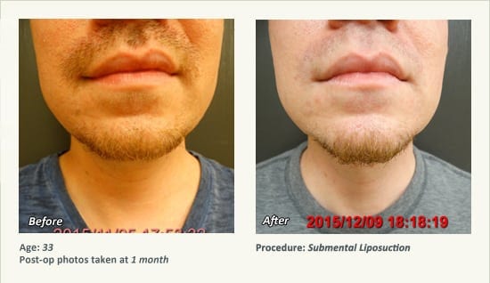 Chin Liposuction in Plano, TX - Patient 47