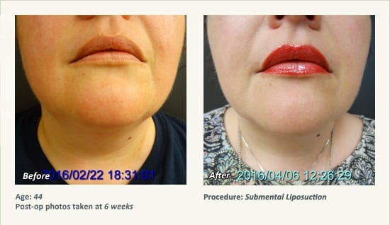 Chin Liposuction in Plano, TX - Patient 49