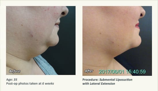 Chin Liposuction in Plano, TX - Patient 52