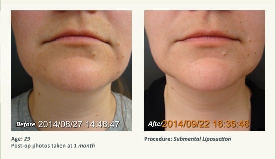 Chin Liposuction in Plano, TX - Patient 53