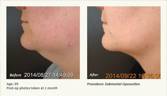 Chin Liposuction in Plano, TX - Patient 54