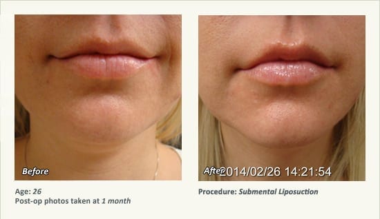 Chin Liposuction in Plano, TX - Patient 55