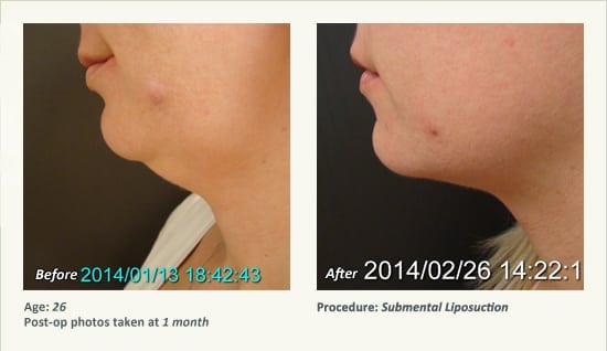 Chin Liposuction in Plano, TX - Patient 56