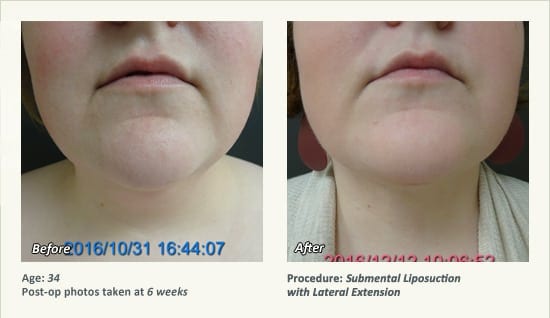 Chin Liposuction in Plano, TX - Patient 57