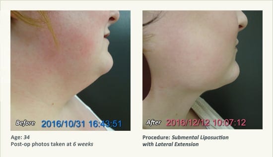 Chin Liposuction in Plano, TX - Patient 58