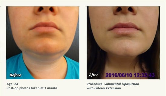 Chin Liposuction in Plano, TX - Patient 59