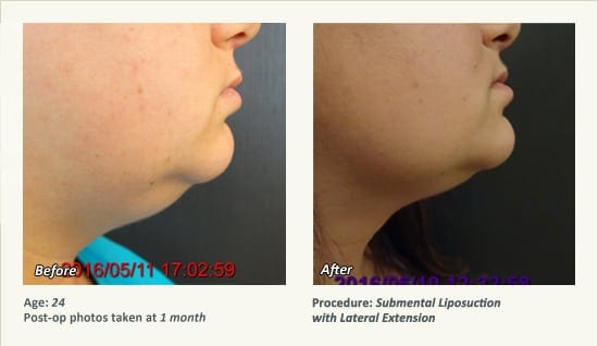 Chin Liposuction in Plano, TX - Patient 60