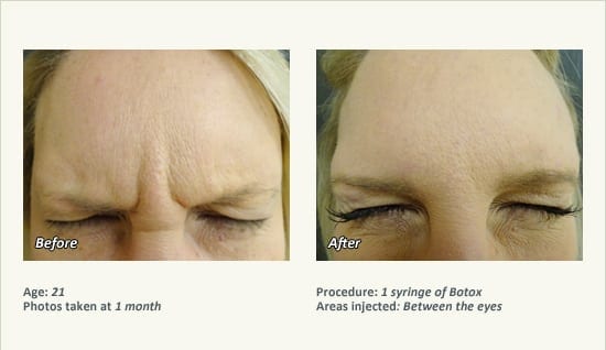 BOTOX® Cosmetic & Dysport® Treatment in Plano & Dallas - Patient 26