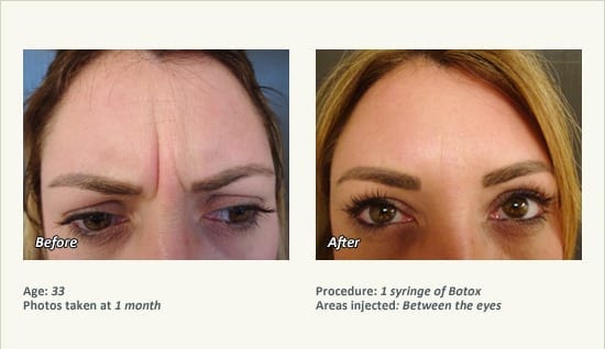 BOTOX® Cosmetic & Dysport® Treatment in Plano & Dallas - Patient 24