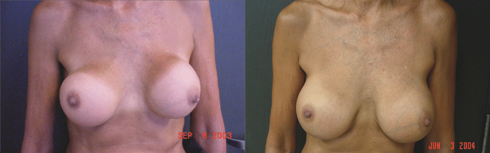 Bulging breast after implants