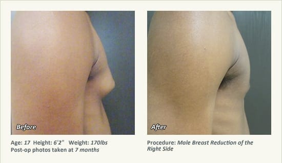 Male Breast Reduction Surgery in Plano, TX - Patient 38