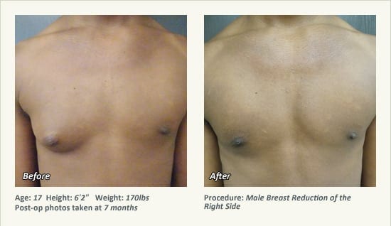 Male Breast Reduction Surgery in Plano, TX - Patient 37