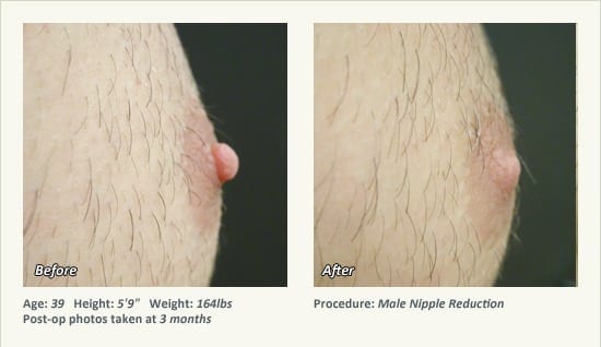 Male Nipple Reduction in Plano, TX - Patient 24