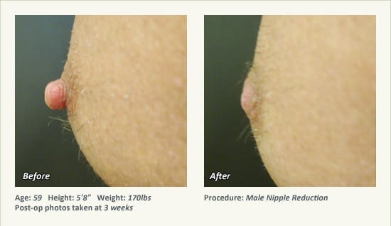 Male Nipple Reduction in Plano, TX - Patient 26