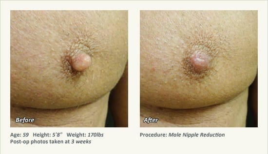 Male Nipple Reduction in Plano, TX - Patient 25
