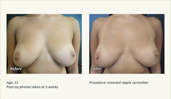 Nipple Procedures (Female) in Plano, TX - Patient 40