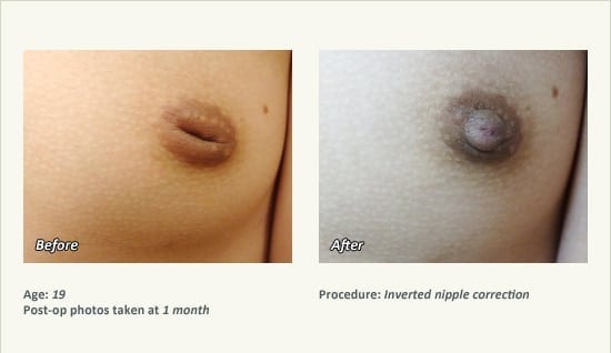 Nipple Procedures (Female) in Plano, TX - Patient 30