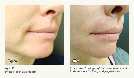 Restylane® & JUVÉDERM® Gel Injectable Fillers In Plano, TX - Patient 39