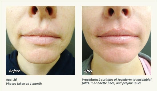 Restylane® & JUVÉDERM® Gel Injectable Fillers In Plano, TX - Patient 40
