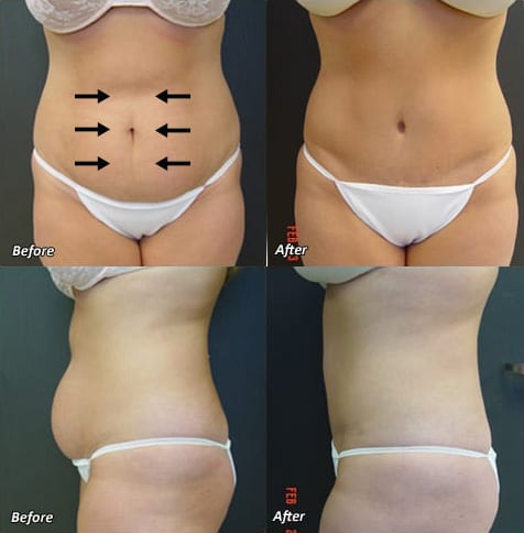 Before & After Tummy Tuck | Ronald M. Friedman, M.D.