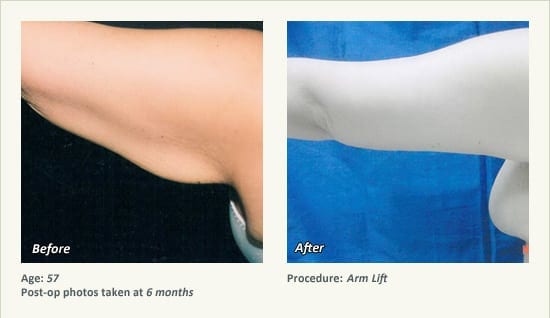 Arm Lift Surgery in Plano, TX - Patient 5