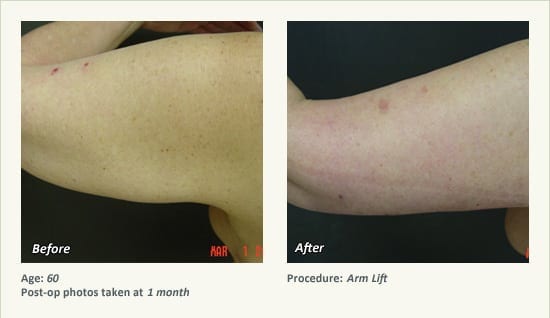 Arm Lift Surgery in Plano, TX - Patient 6