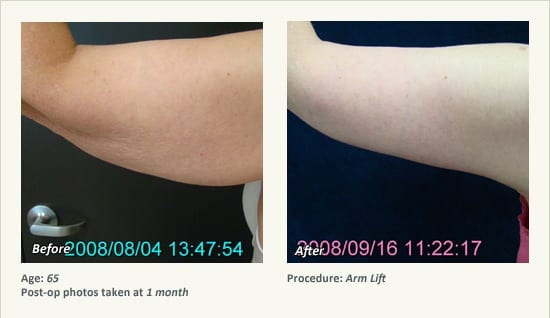 Arm Lift Surgery in Plano, TX - Patient 7