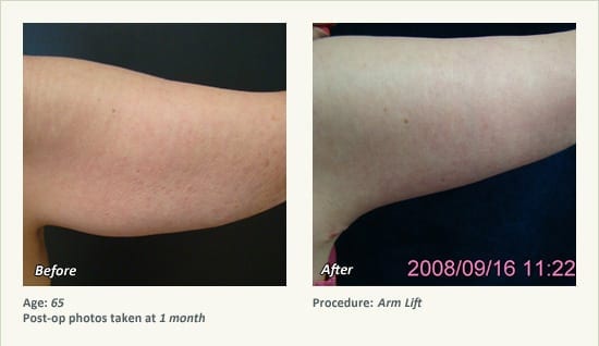 Arm Lift Surgery in Plano, TX - Patient 8