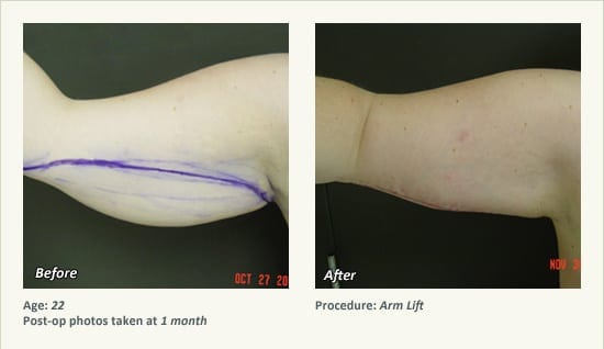 Arm Lift Surgery in Plano, TX - Patient 10